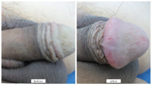 【症例020】亀頭増大術