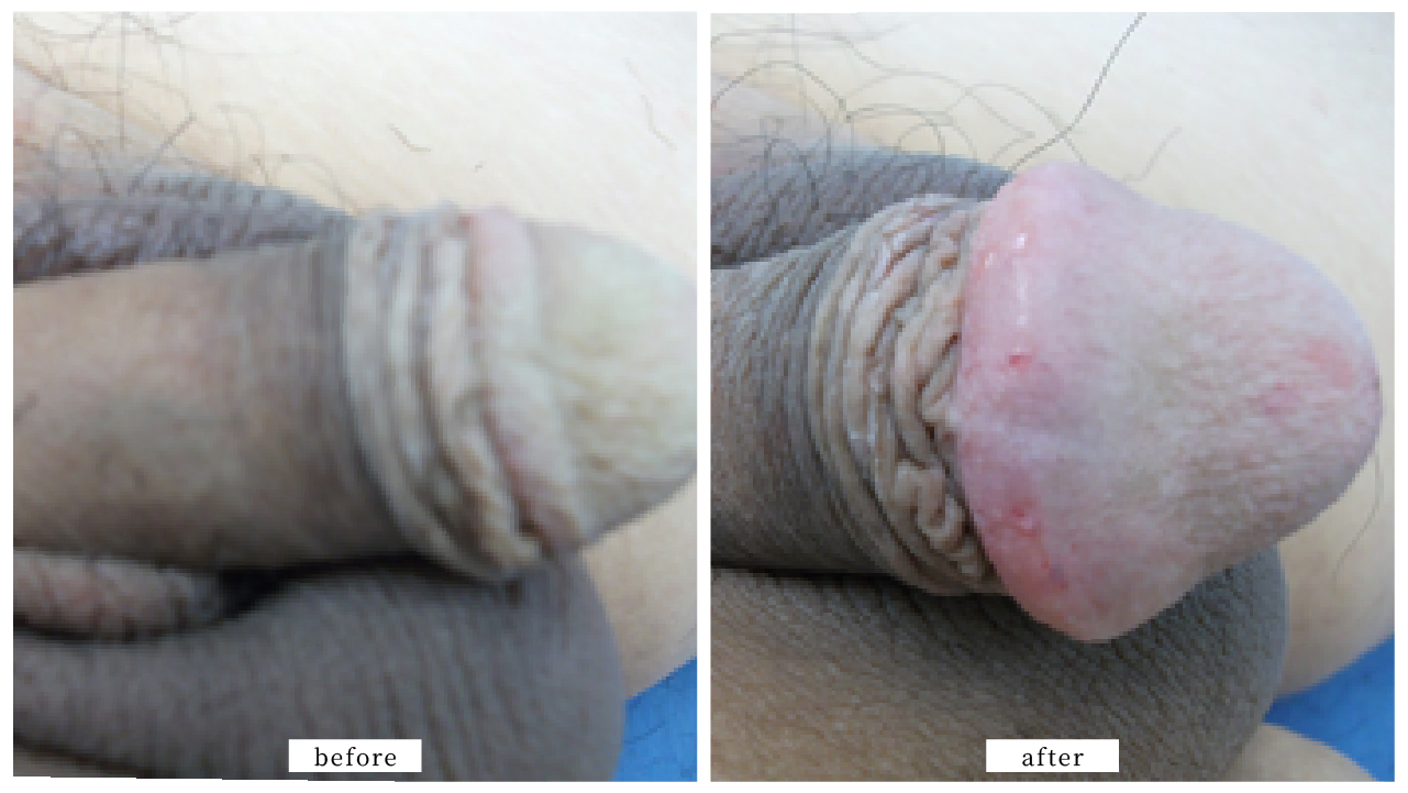 【症例020】亀頭増大術