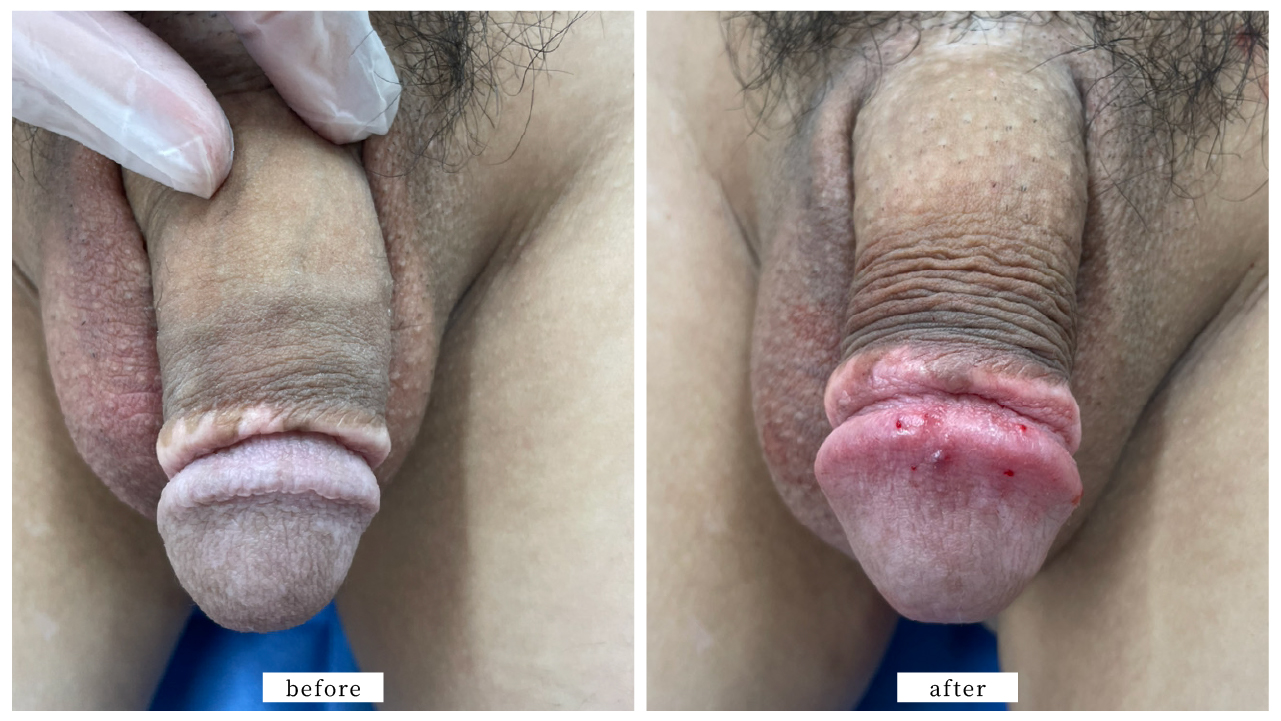 【症例021】亀頭増大術