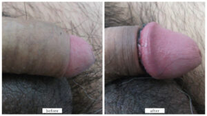 【症例003】カントン包茎（切る包茎手術）＋亀頭増大術