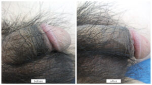 【症例009】長茎術