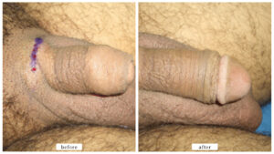 【症例010】長茎術