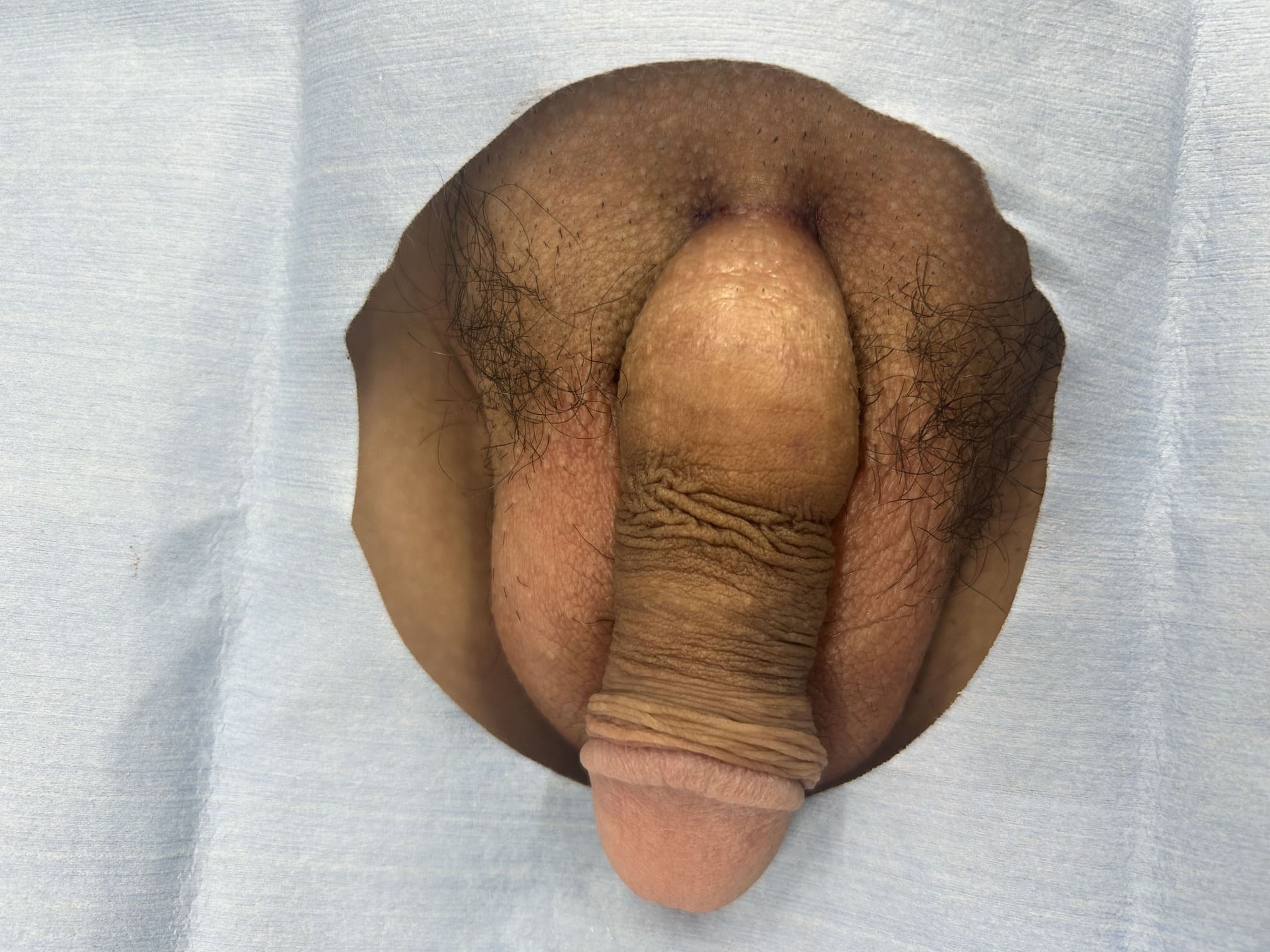 【症例012】長茎術（術後）①