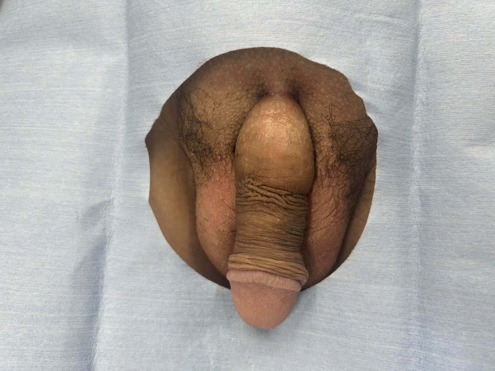 【症例012】長茎術（術後）②