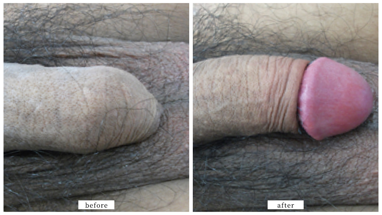 【症例004】真性包茎（切る包茎手術）＋亀頭増大術