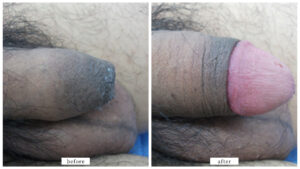 【症例005】真性包茎（切る包茎手術）