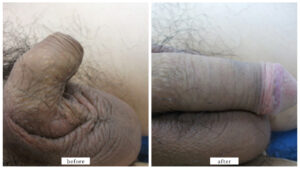 【症例006】真性包茎（切る包茎手術）＋亀頭増大術＋長茎術