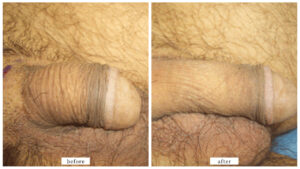 【症例007】長茎術