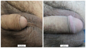 【症例008】長茎術