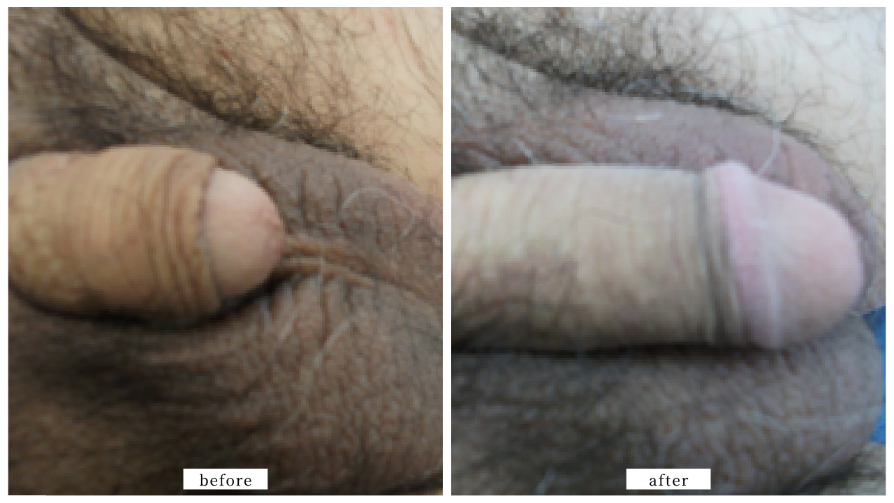 【症例008】長茎術