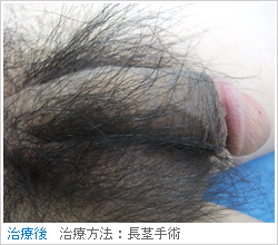 長茎術（施術後）