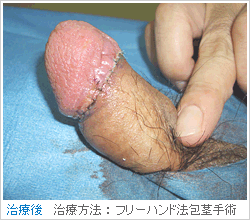 カントン包茎（うっ血）アフター