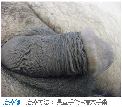 【症例014】長茎術（術後）