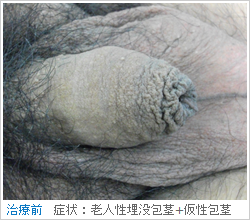 仮性包茎（亀頭増大術前）
