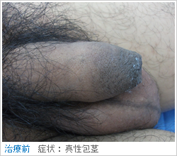 真性包茎（手術前）