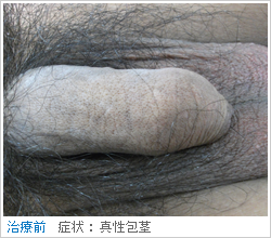 真性包茎（手術前）