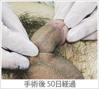 【症例013】長茎術（術後）④