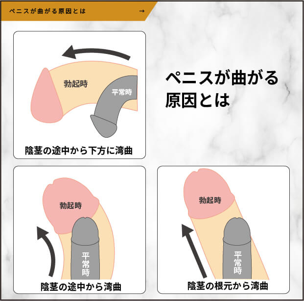 ペニスが曲がる原因
