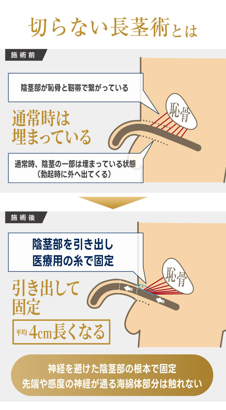 長茎術の仕組み