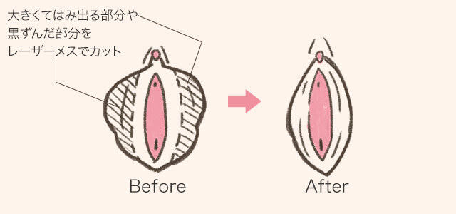 ビラビラを小さくする小陰唇縮小術