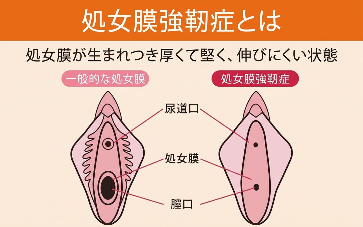 処女膜強靭症（肥厚性処女膜）とは